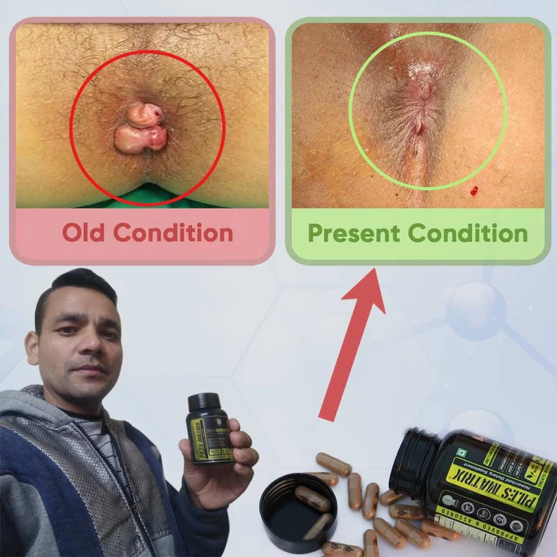 YogaManLab® PILES MATRIX - Ayurvedic Medicines for Piles Home Treatment | With Capsules, Lepam & Diet Booklet | Relives Pain & Itching, Shrinks Mass, & Treats Constipation | 100% Natural