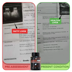 YogaManLab® Liver Pro - Fatty Liver Ayurvedic Supplement | Helps Restore Liver Health & Remove Toxins | 100% Natural & Ayurvedic | 28 Days Program
