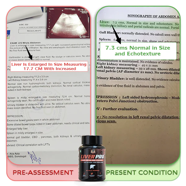 YogaManLab® Liver Pro - Fatty Liver Ayurvedic Supplement | Helps Restore Liver Health & Remove Toxins | 100% Natural & Ayurvedic | 28 Days Program