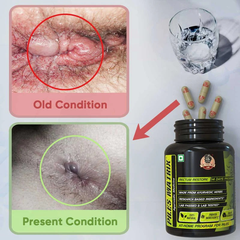 YogaManLab® PILES MATRIX - Ayurvedic Medicines for Piles Home Treatment | With Capsules, Lepam & Diet Booklet | Relives Pain & Itching, Shrinks Mass, & Treats Constipation | 100% Natural