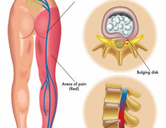 YogaManLab® Posture Corrector Belt - Back Pain, Hips Pain, Sciatica Pain - Corrects Hump Back